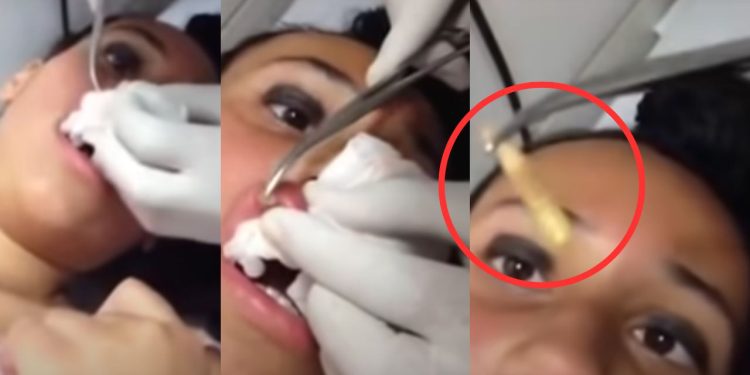 Circula nas redes sociais o vídeo que mostra um médico lutando para remover uma larva do lábio superior de uma paciente.