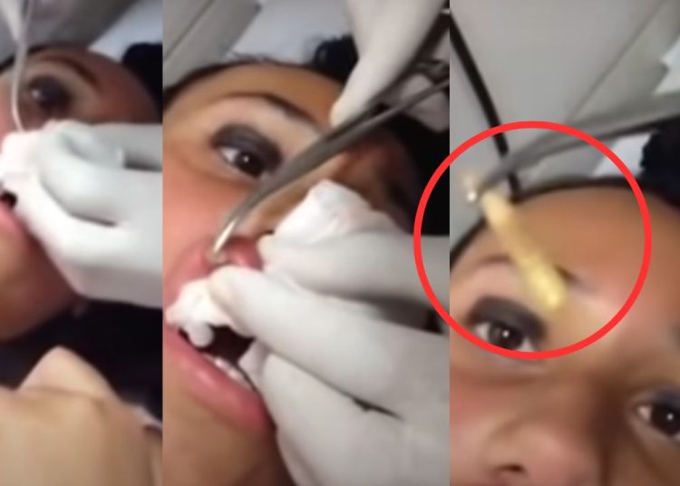 Circula nas redes sociais o vídeo que mostra um médico lutando para remover uma larva do lábio superior de uma paciente.