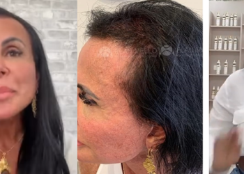 Gretchen revela que está lutando para não ficar careca; veja vídeo