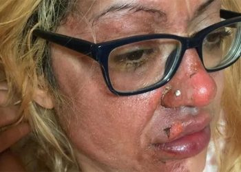 Uma mulher britânica sofreu queimaduras terríveis após tentar cozinhar um ovo no micro-ondas. Por causa do acidente, ela emitiu. Ovo explode.