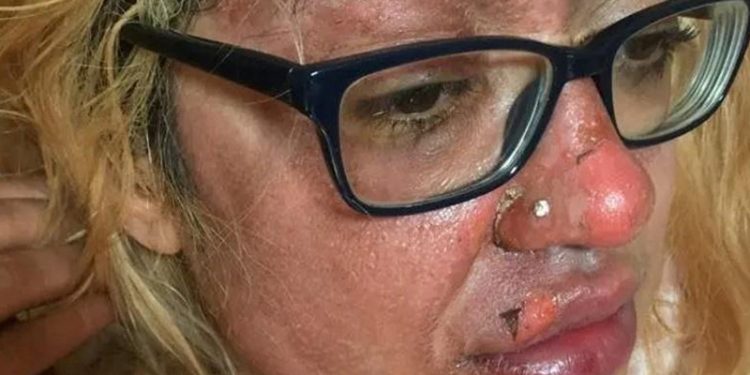 Uma mulher britânica sofreu queimaduras terríveis após tentar cozinhar um ovo no micro-ondas. Por causa do acidente, ela emitiu. Ovo explode.