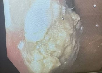 Um menino de 5 anos deu entrada em um pronto-socorro em Ohio, nos Estados Unidos, com fortes dores abdominais e diarreia, depois. Menino de