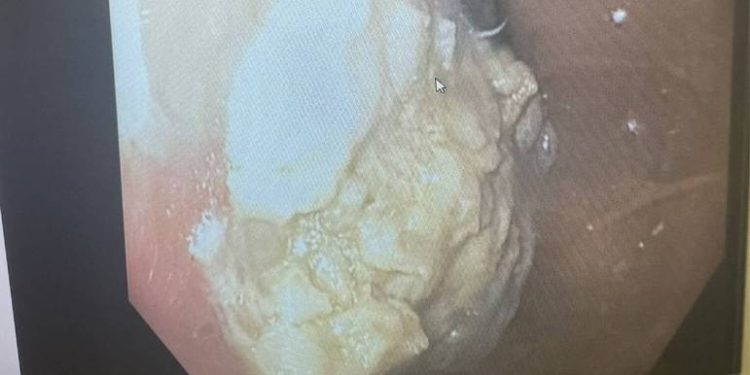 Um menino de 5 anos deu entrada em um pronto-socorro em Ohio, nos Estados Unidos, com fortes dores abdominais e diarreia, depois. Menino de