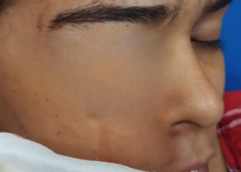 Uma mulher identificada por Ketlen Renata Costa Rocha, 22, está correndo o risco de perder a visão do olho esquerdo, após ser. Mulher é