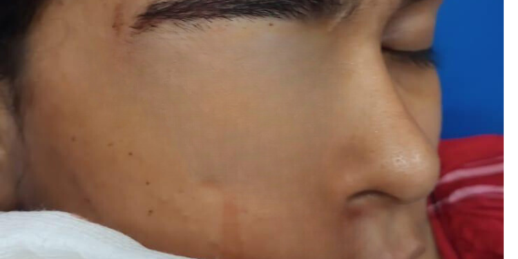 Uma mulher identificada por Ketlen Renata Costa Rocha, 22, está correndo o risco de perder a visão do olho esquerdo, após ser. Mulher é