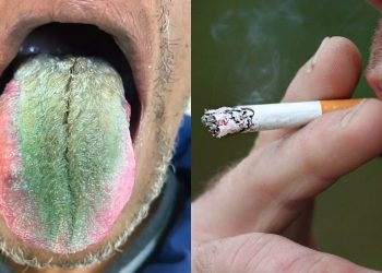 Homem tem reação e fica com a língua verde e peluda após fumar cigarro
