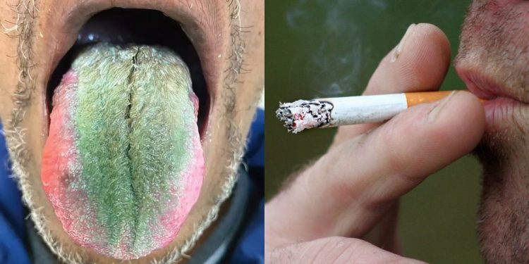 Homem tem reação e fica com a língua verde e peluda após fumar cigarro