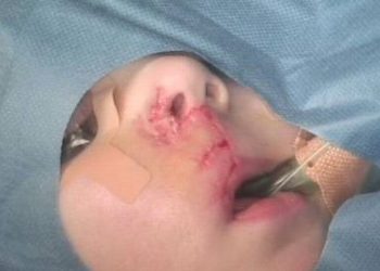 Menino de três anos perde 60% do lábio após ser atacado por Buldogue francês