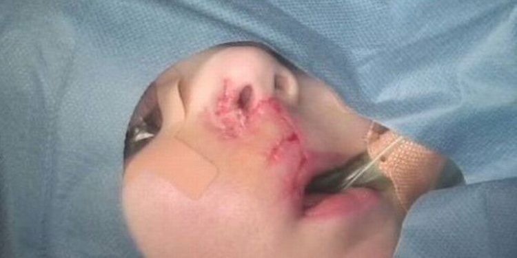 Menino de três anos perde 60% do lábio após ser atacado por Buldogue francês