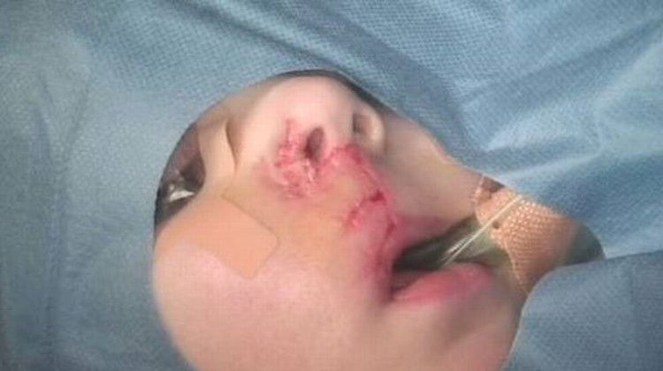 Menino de três anos perde 60% do lábio após ser atacado por Buldogue francês
