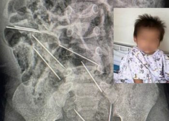 Médicos retiram 8 agulhas de barriga de menino de 2 anos