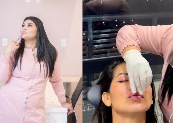 Mitos e verdades: Dra. Eli Almeida esclarece tabus sobre o preenchimento labial
