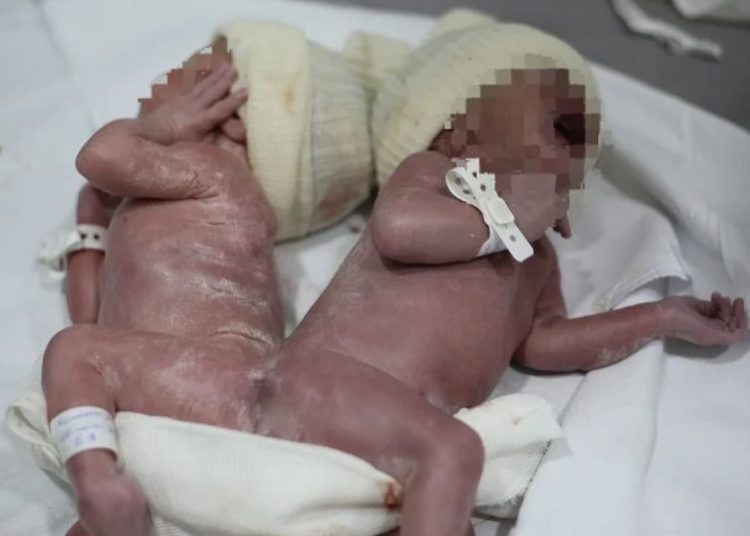 Em caso raro, gêmeos nascem unidos por osso da coluna no Paraná