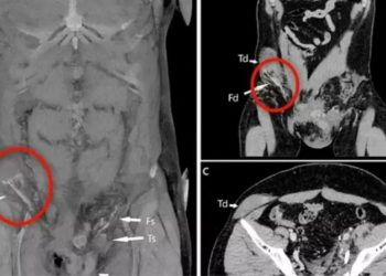 Bizarro: Testículo vai parar no abdômen após homem sofrer acidente de moto