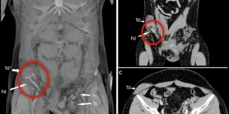 Bizarro: Testículo vai parar no abdômen após homem sofrer acidente de moto