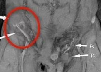 Essa doeu: homem sofre acidente de moto e ‘saco’ vai parar no abdômen