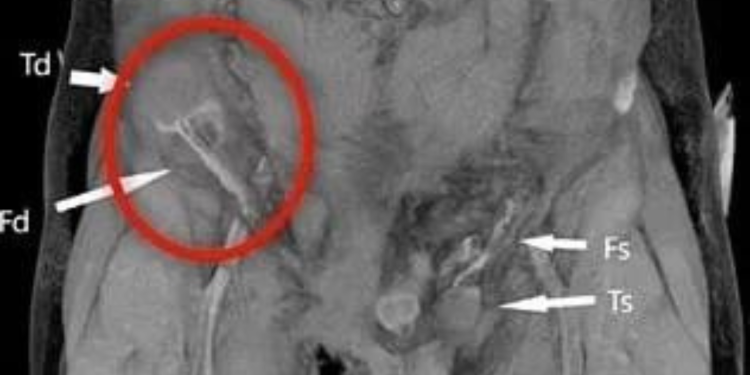 Essa doeu: homem sofre acidente de moto e ‘saco’ vai parar no abdômen