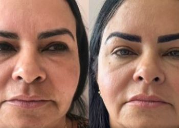 Pdex 26: Dra. Eliane Almeida fala sobre o SkinBooster