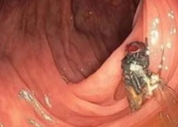 Médicos encontram mosca viva dentro de intestino de paciente