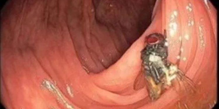 Médicos encontram mosca viva dentro de intestino de paciente