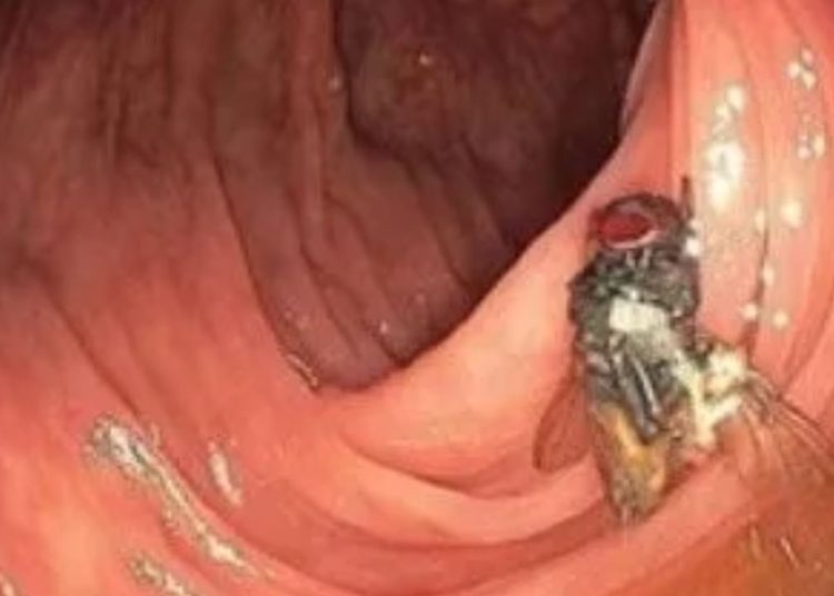 Médicos encontram mosca viva dentro de intestino de paciente