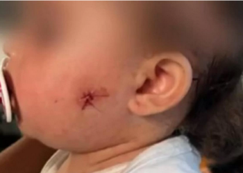 Uma bebê de um ano foi baleada no rosto por um PM que usava uma arma do tipo airsoft. O caso aconteceu na zona leste. PM atira