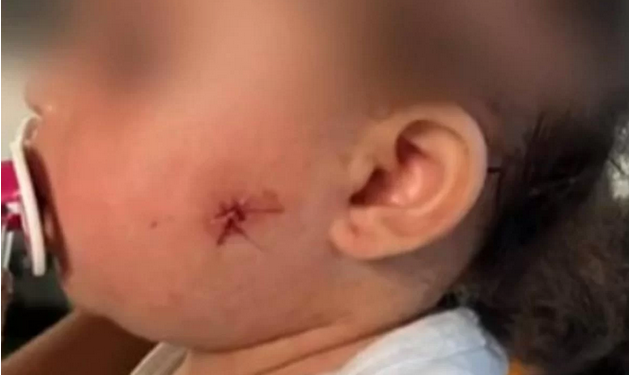 Uma bebê de um ano foi baleada no rosto por um PM que usava uma arma do tipo airsoft. O caso aconteceu na zona leste. PM atira