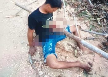 O jovem Igor Silva de Oliveira, de 20 anos, sofreu um grave acidente de motocicleta e ficou com um tronco de árvore atravessado. Jovem sofre