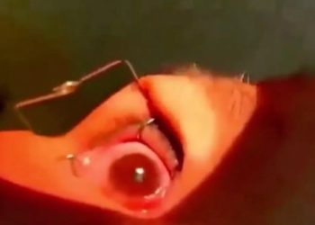 Médicos retiraram mais de 60 vermes vivos dos olhos de uma paciente, durante uma operação ocular de emergência. Mais de