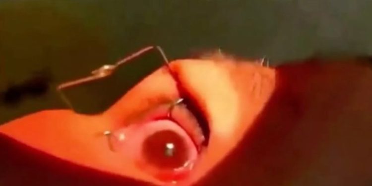 Médicos retiraram mais de 60 vermes vivos dos olhos de uma paciente, durante uma operação ocular de emergência. Mais de