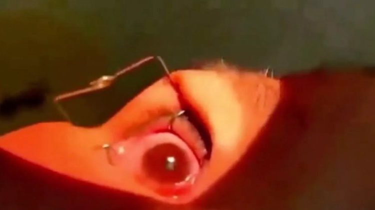 Médicos retiraram mais de 60 vermes vivos dos olhos de uma paciente, durante uma operação ocular de emergência. Mais de
