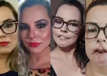 Influenciadora perde o lábio superior após fazer preenchimento