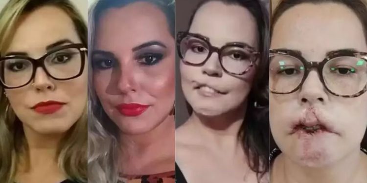 Influenciadora perde o lábio superior após fazer preenchimento