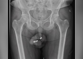 Um idoso de 73 anos, que sofria com um quadro de impotência sexual, precisou ser submetido a duas. Com impotência