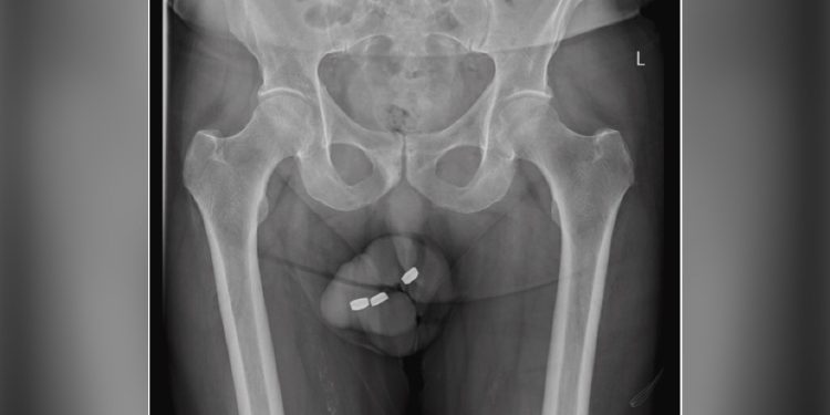 Um idoso de 73 anos, que sofria com um quadro de impotência sexual, precisou ser submetido a duas. Com impotência