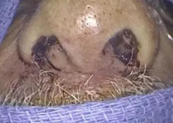 Um homem procurou o hospital após sentir o rosto e lábios inchados e ao fazer exames foi constatado que. Chocante: