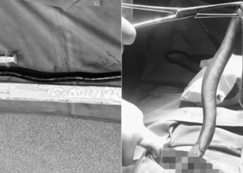 Um homem de 34 anos foi operado após uma enguia entrar em seu ânus. O caso aconteceu na quarta-feira. Chocante: