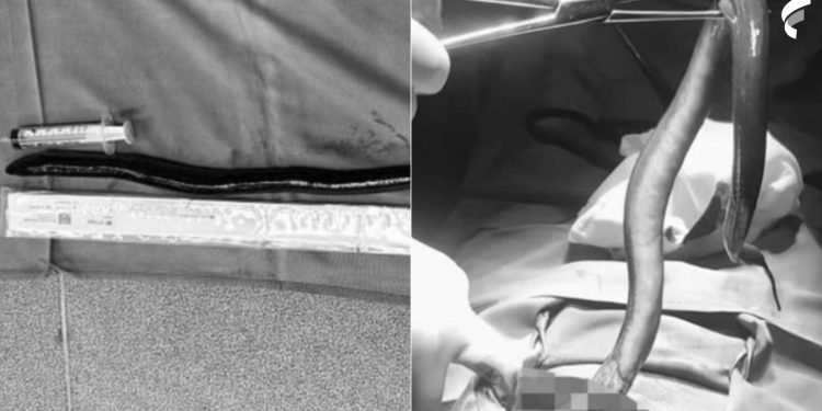 Um homem de 34 anos foi operado após uma enguia entrar em seu ânus. O caso aconteceu na quarta-feira. Chocante: