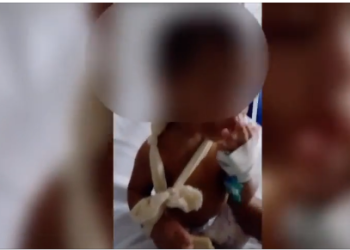 VIOLÊNCIA | Bebê de 1 ano tem clavícula quebrada com mãos e pés queimados