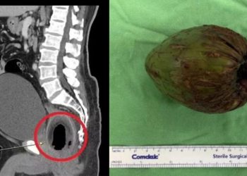 Prazer bizarro: Homem faz cirurgia para tirar coco de 9cm do rabo