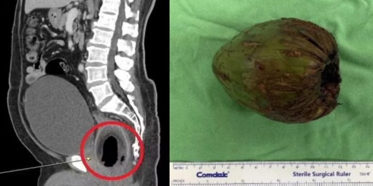 Prazer bizarro: Homem faz cirurgia para tirar coco de 9cm do rabo