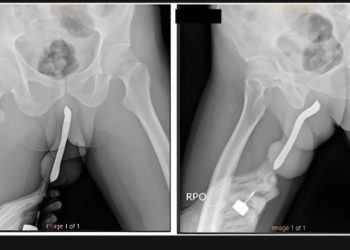 Durante o ‘vuco-vuco’, homem enfia escova de dente no ‘bilau’ e objeto quebra