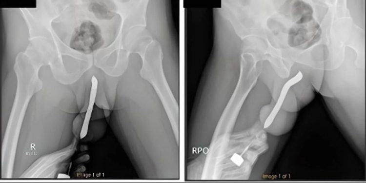 Durante o ‘vuco-vuco’, homem enfia escova de dente no ‘bilau’ e objeto quebra