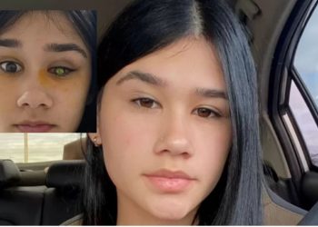 A estudante Lara Brandão Tironi, 18, perdeu a visão do olho direito após usar incorretamente lentes de. 'Perdi