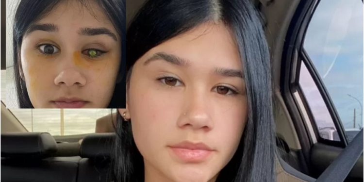 A estudante Lara Brandão Tironi, 18, perdeu a visão do olho direito após usar incorretamente lentes de. 'Perdi