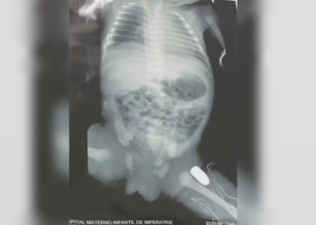 Uma adolescente grávida de 16 anos, com nove meses de gestação, foi baleada durante um assalto em. Grávida é