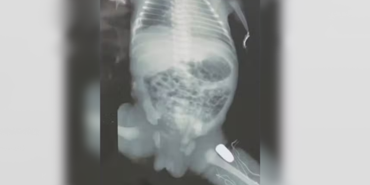 Uma adolescente grávida de 16 anos, com nove meses de gestação, foi baleada durante um assalto em. Grávida é