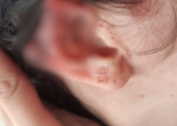 Durante briga, homem morde a orelha da namorada e arranca o pedaço