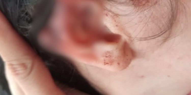 Durante briga, homem morde a orelha da namorada e arranca o pedaço