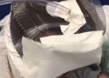 Hospital usa embalagem de bolo como máscara de oxigênio para bebê